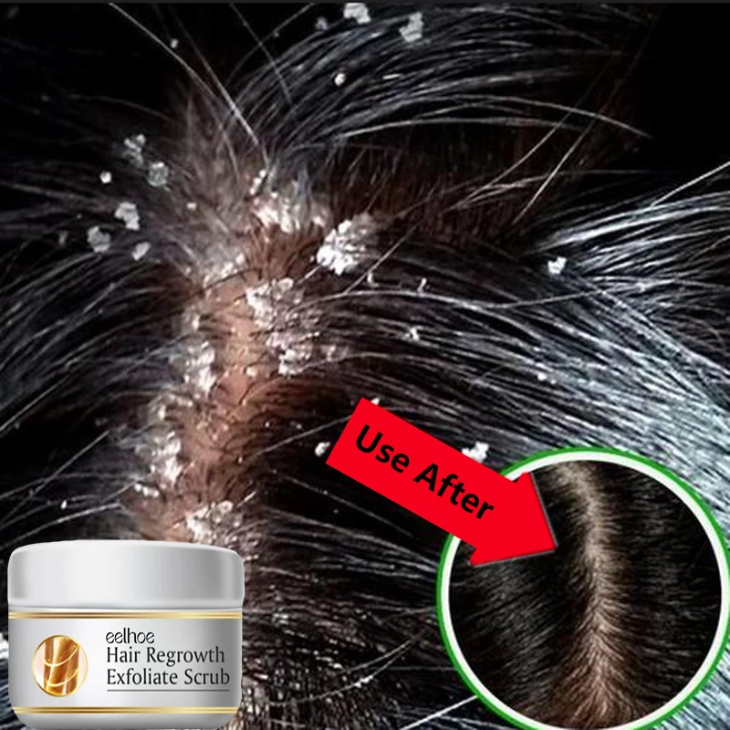Hair Care Dandruff - Schnelle Anti-Schuppen-Haarbehandlung, Peeling gegen Juckreiz, Kopfhautreinigung,