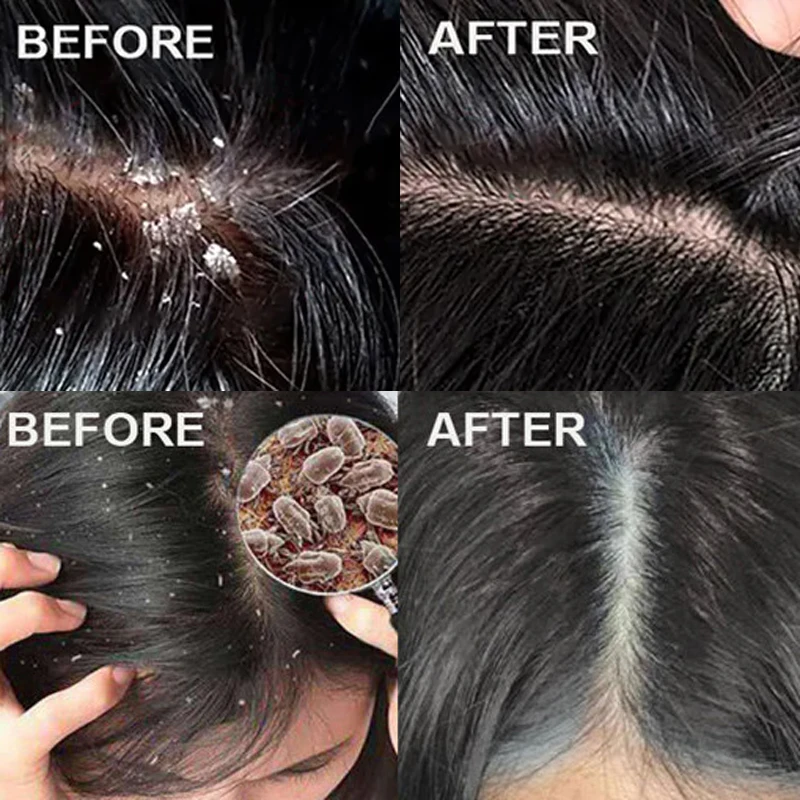 Schnelle Anti-Schuppen-Haarbeh – Hair Care Dandruff Bewertung und Preis