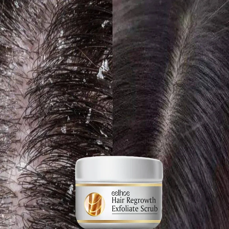 Schnelle Anti-Schuppen-Haarbeh – Hair Care Dandruff Bewertung und Preis
