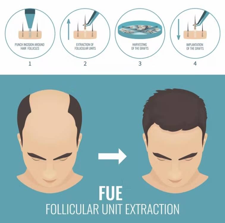 Fue Haar implantat Mikro motor – Hair Care Products Bewertung und Preis